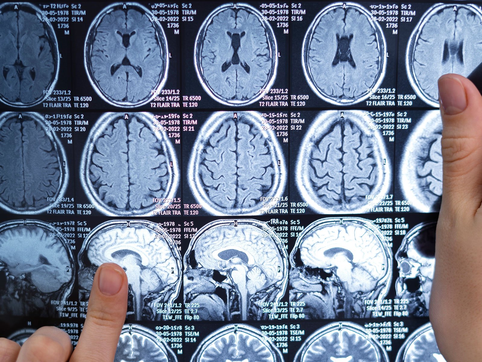 AVC mata 1 pessoa a cada 6 minutos e gera custo hospitalar de quase R$ 1 bilhão em seis anos