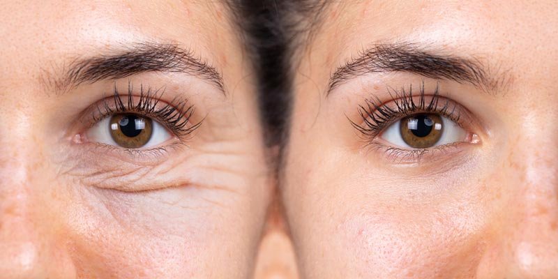 Sudeste lidera aumento das cirurgias de Blefaroplastia