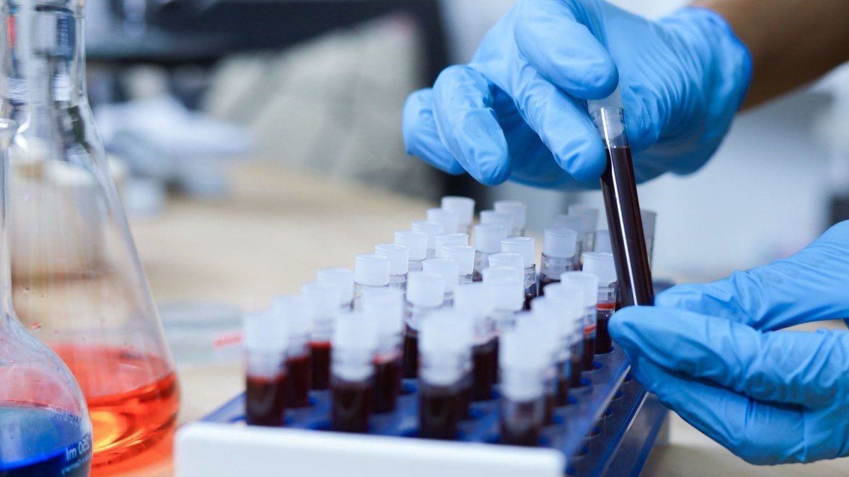 Anvisa aprova exame de sangue para diagnosticar Doença de Alzheimer